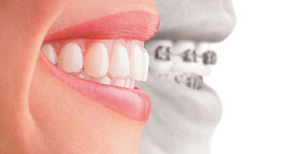Laurel Dentist Invisalign Smile