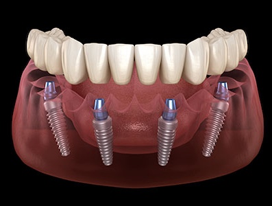 oral Surgery Laurel Maryland