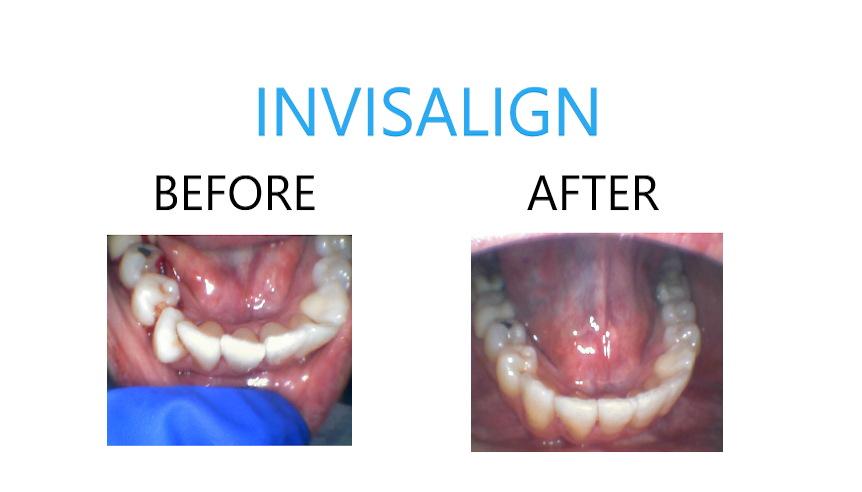 Laurel Invisalign