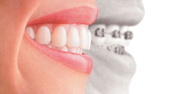 laurel invisalign Specials