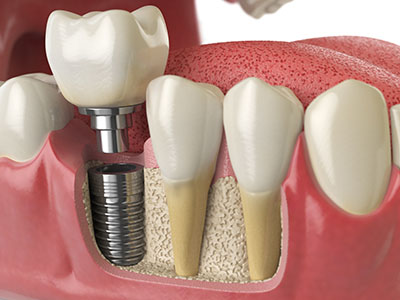 Gum disease and periodontal treatment by Dr. Robin Pollack in Laurel, MD