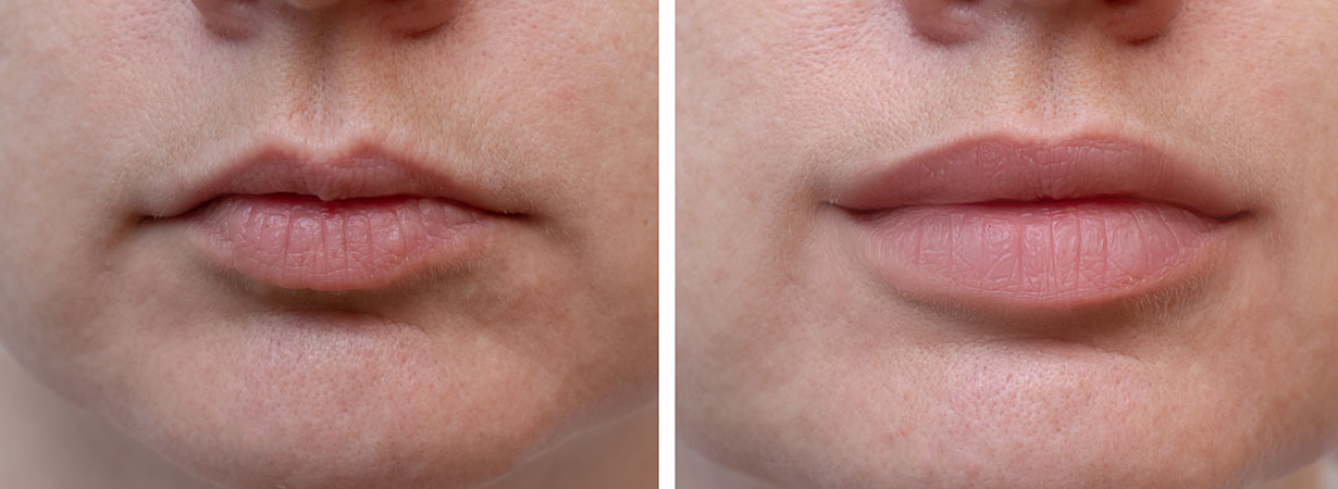 Lip Filler in Laurel